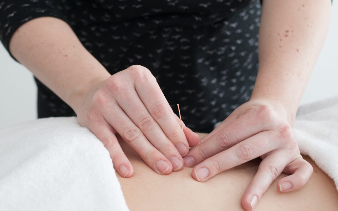 What is The Difference Between Acupuncture, Neurofunctional Acupuncture and Dry Needling?