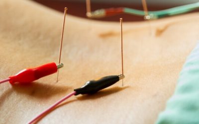 Acupuncture in Elora: How Neurofunctional Acupuncture / Electroacupuncture Supports Pain Relief and Recovery